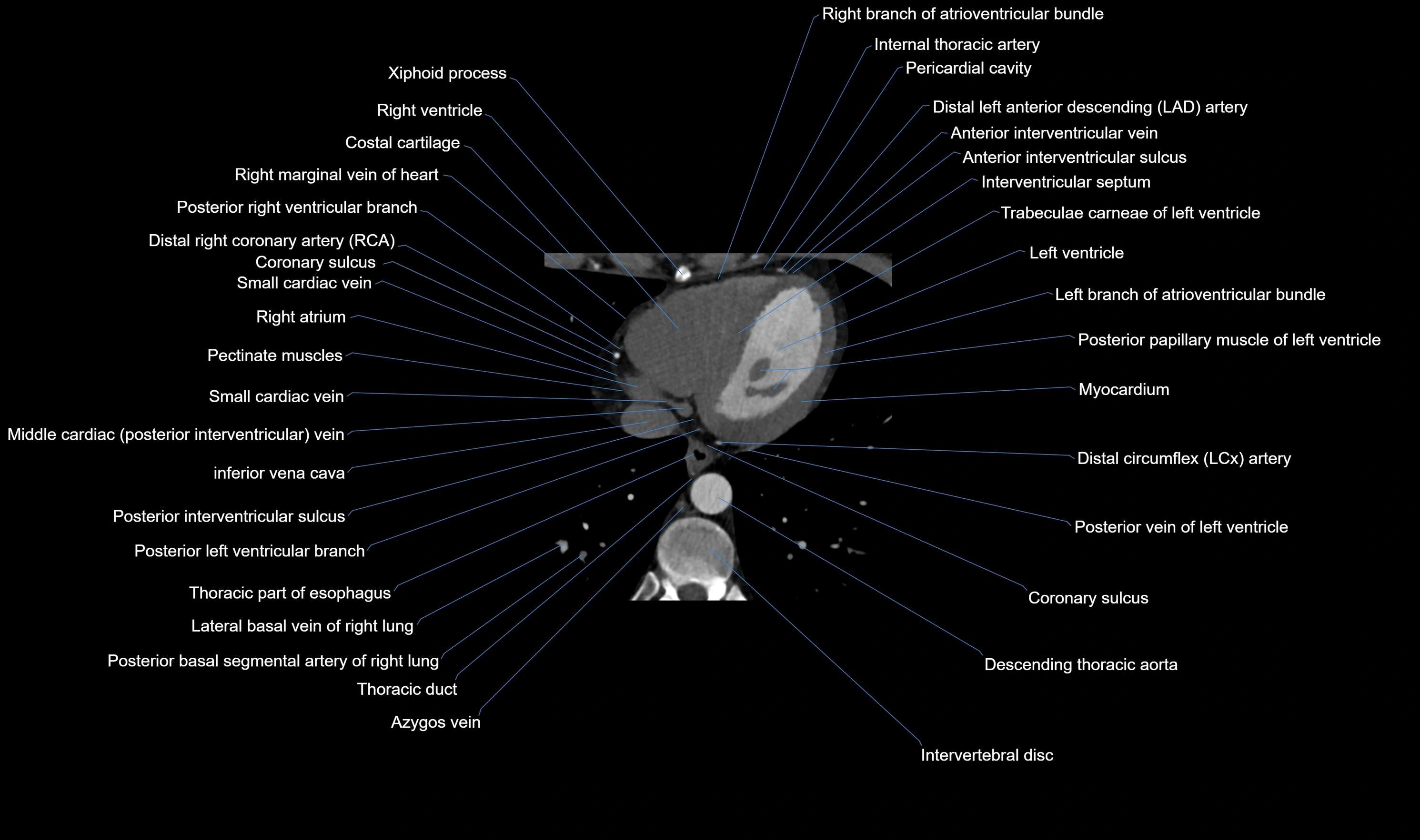 CT heart (coronary angiogram) axial view cross sectional anatomy labelled radiology image-00055.webp